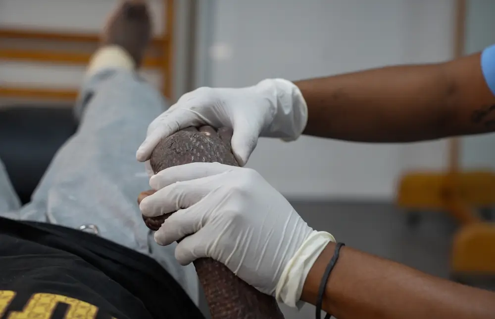 Un fisioterapeuta durante una sesión con un paciente quemado en el hospital de MSF en Tabarre.