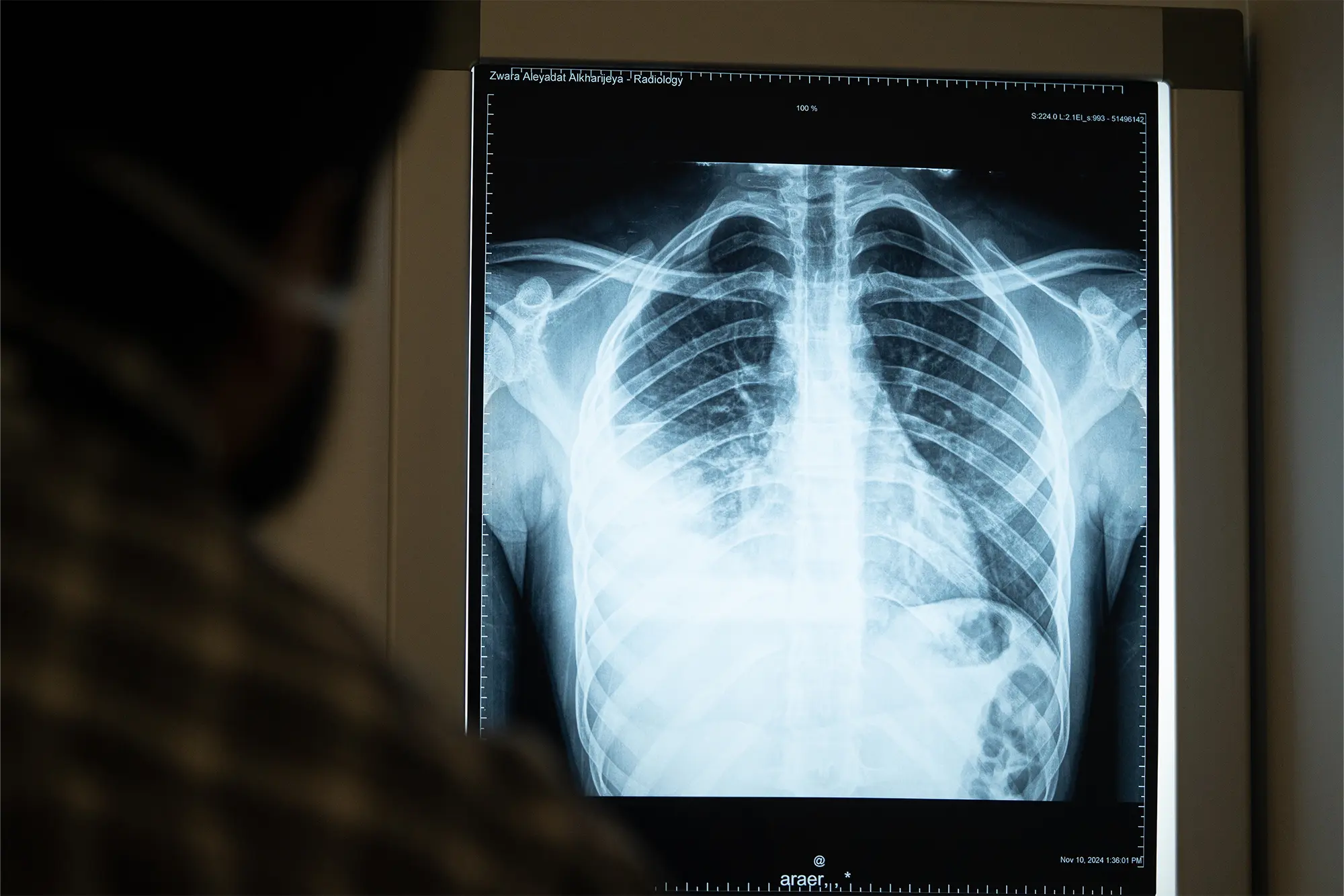 Un médico de MSF revisa la radiografía de tórax de un paciente sospechoso de tener tuberculosis en Zuwara, Libia, noviembre de 2024.