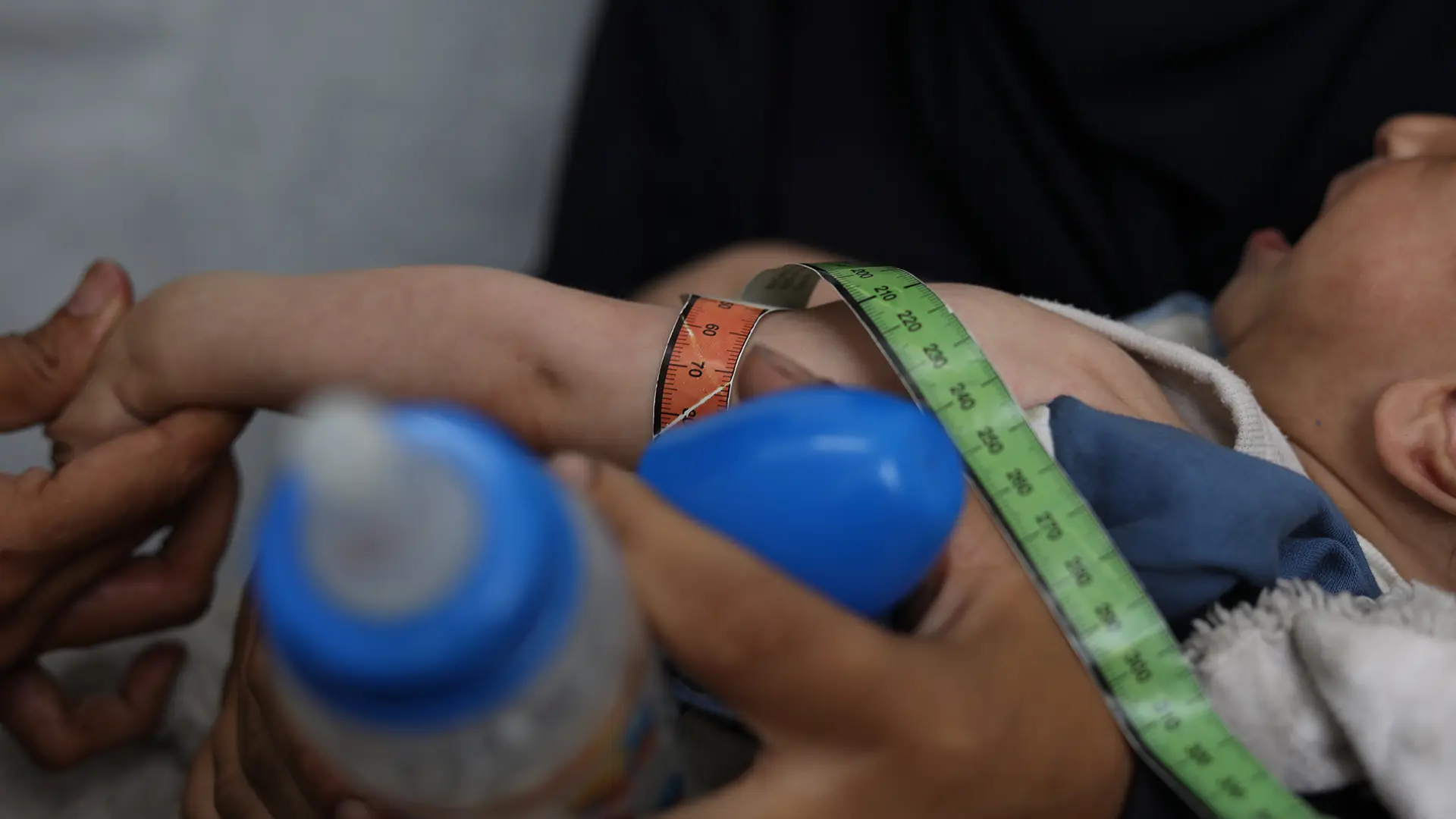 Un niño palestino que sufre desnutrición se somete a un chequeo médico en una clínica de MSF en la ciudad de Gaza.