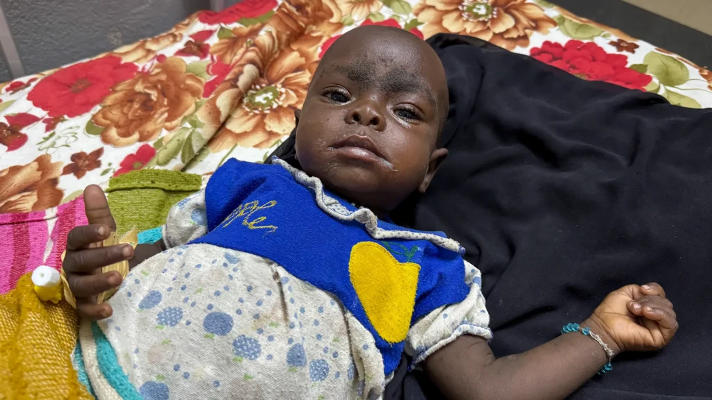 Nastrin de 10 meses padece desnutrición y sarampión, una combinación mortal en una zona de guerra. Darfur, Sudán, 2025.